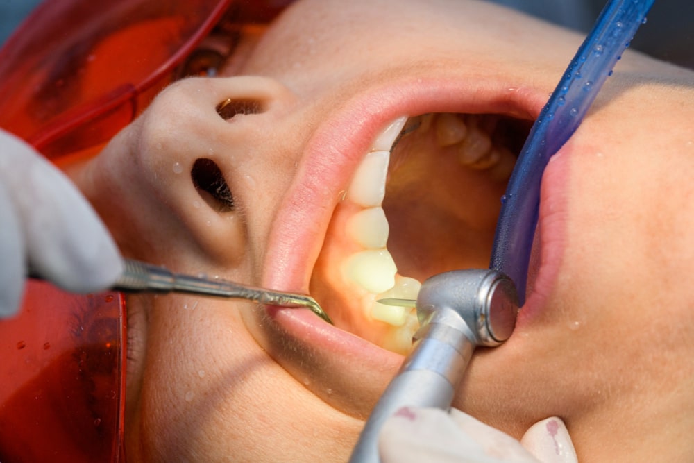 DENTISTE Montréal: Traitement de Canal: Micro Endodontie