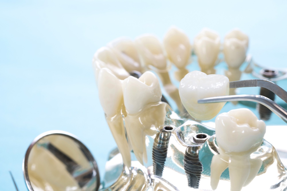 The Dental Implant: Different Functions
