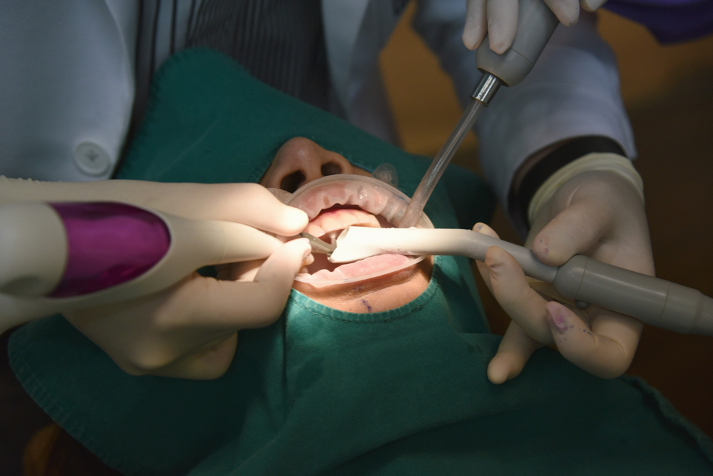 abcess Dental Abscess