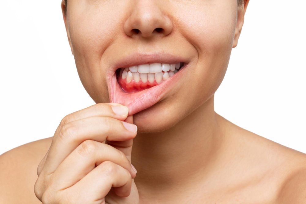 person on white background pulling their bottom lip showing irritated gums because of excessive alcohol