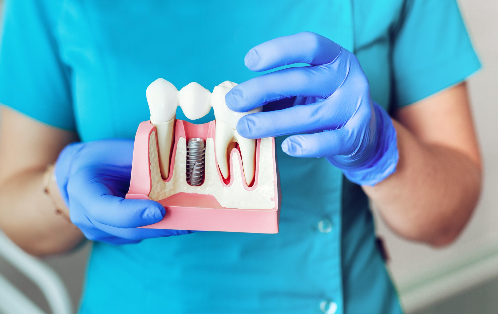 boucherville dentist showing and explaining a visual example of a tooth implant