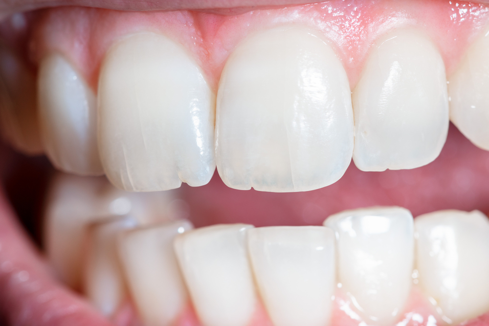 Picture of damaged teeth